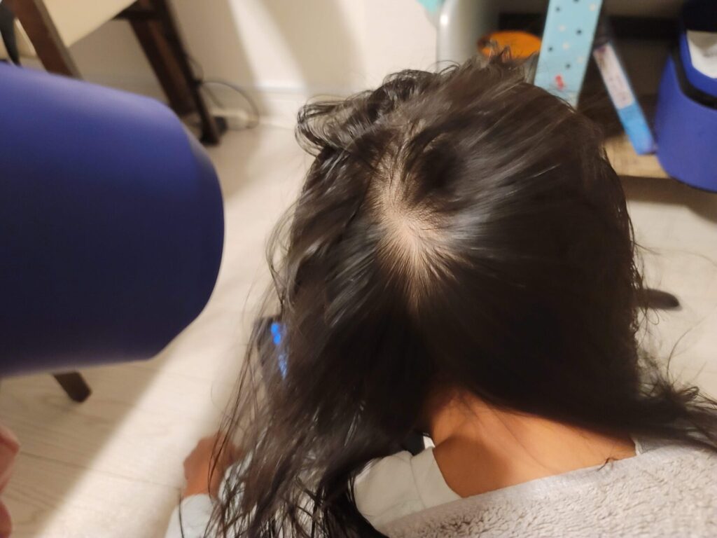 ダイソンヘアドライヤーで髪の毛を乾かしているところ。頭皮が見えている。